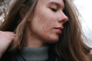 hypnotherapy for skin problems, a woman with acne